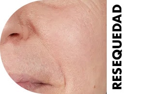 skinare resequedad