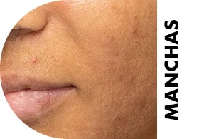 skincare para manchas