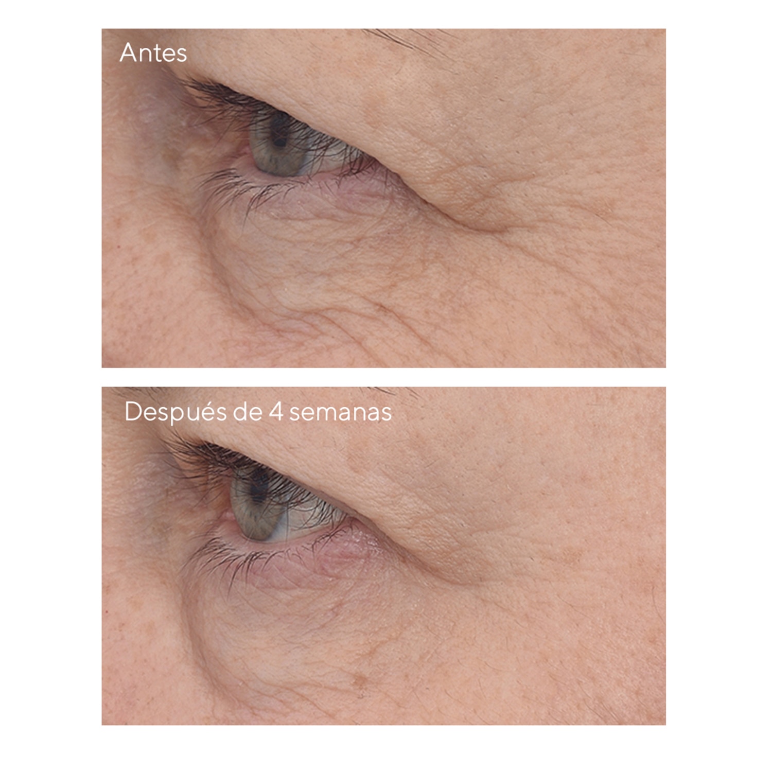 retina antes y despues del acne