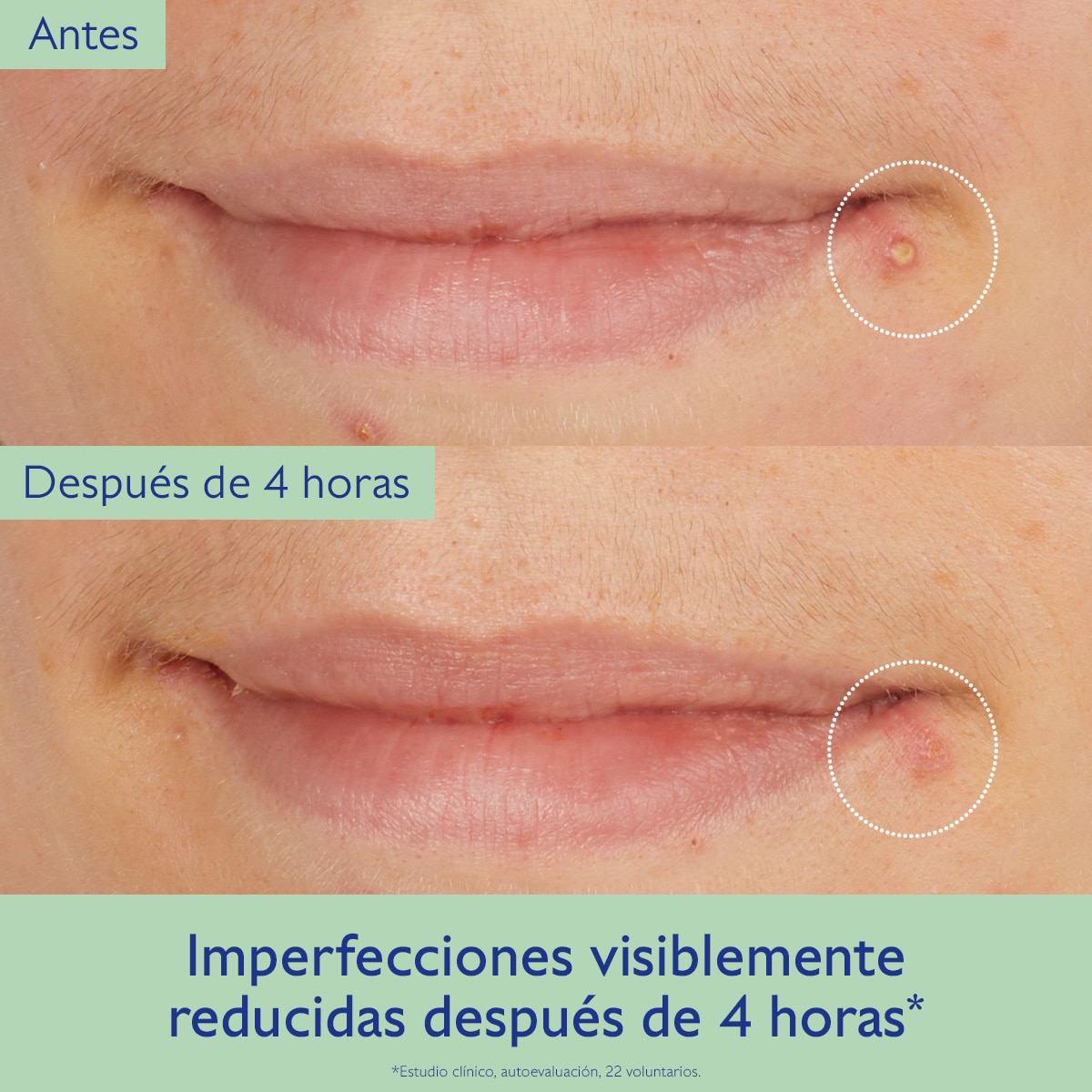 VINOPURE TRATAMIENTO DE ÁCIDO SALICĪLICO NATURAL (TRATAMIENTO DE ÁCIDO SALICÍLICO)
