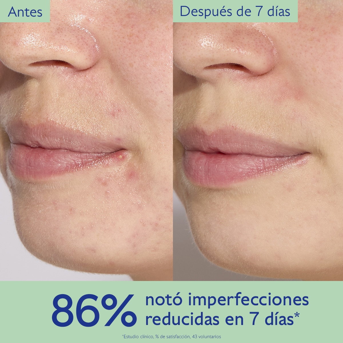 VINOPURE SERUM TRATAMIENTO PARA EL ACNÉ CON ÁCIDO SALICÍLICO (TRATAMIENTO PARA EL ACNÉ)